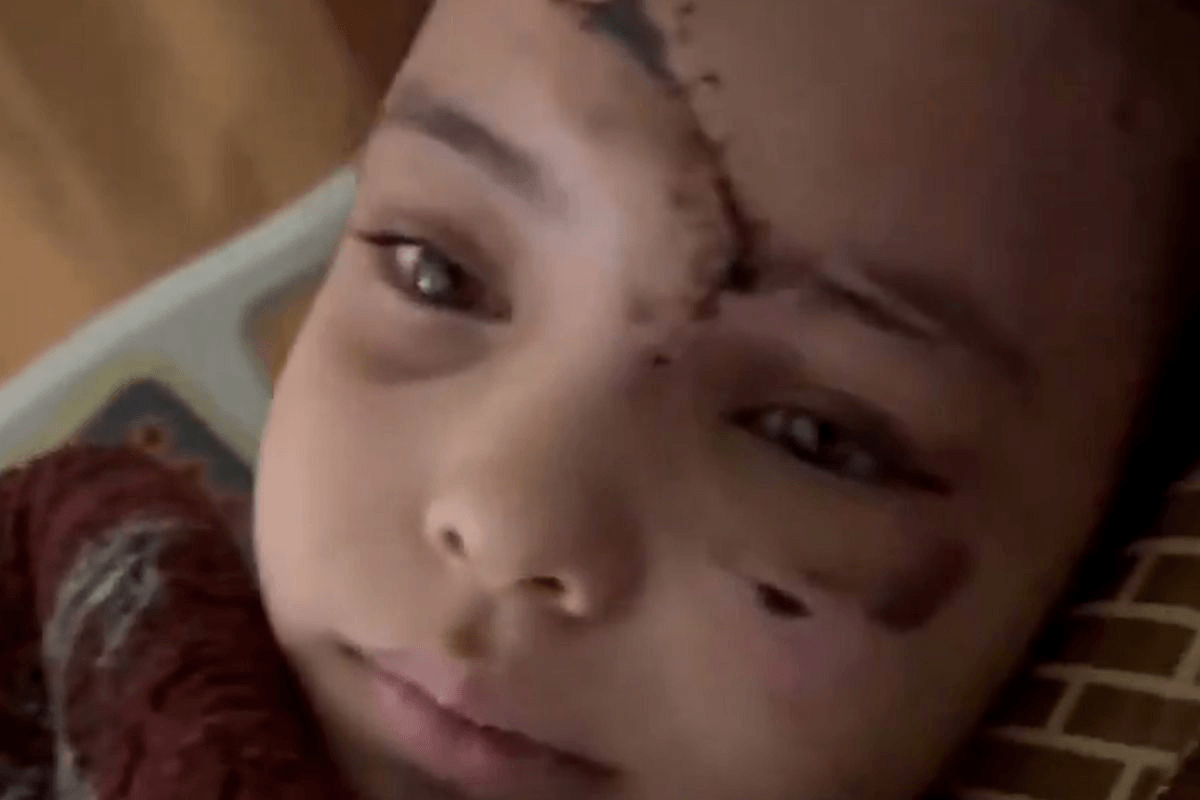 A Gazan child with head injuries from an Israeli air strike wishes for permanent ceasefire