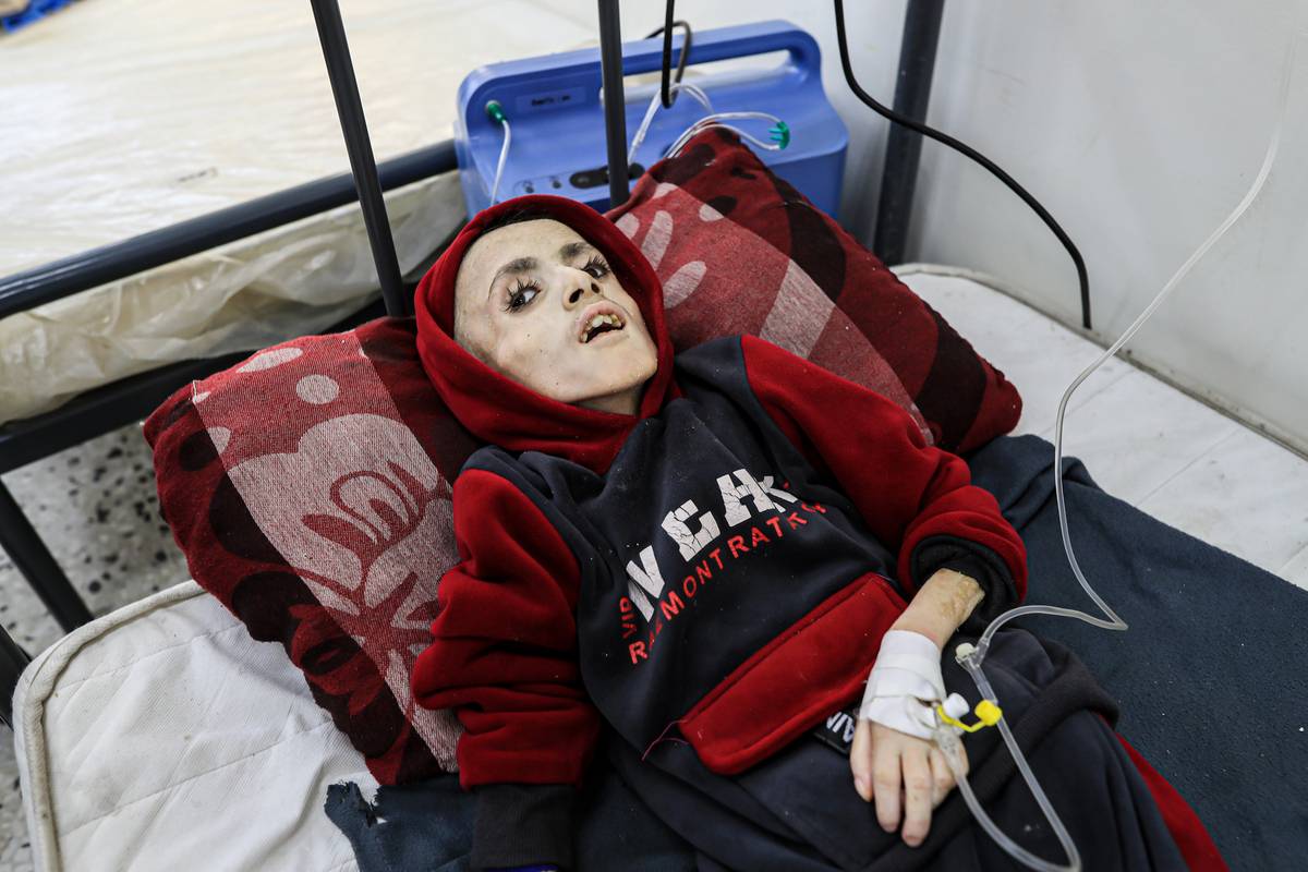 Yezen Al-Kfarna, a 10 year old Palestinian boy who suffers malnourishment due to the ongoing Israeli blockade receives medical treatment with limited resources at Abu Yusuf al-Najjar Hospital in Rafah, Gaza on February 28, 2024. [Jehad Alshrafi - Anadolu Agency]