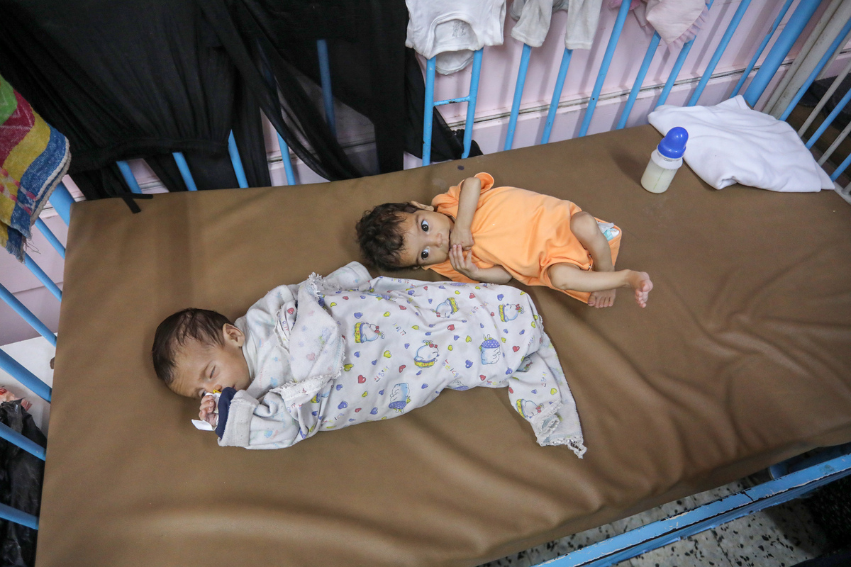 Palestinian children, who have been losing weight due to malnutrition, is seen at Nasser Hospital in Khan Yunis, Gaza, on July 24, 2025. [Abed Rahim Khatib - Anadolu Agency]