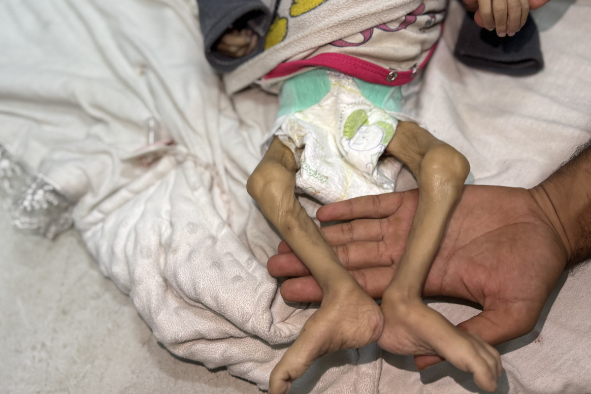 The dead body of 6-month-old baby Zeyneb Abu Halib, who died due to malnutrition, is seen at the Nasser Hospital in Khan Yunis, Gaza, on July 25, 2025. [Abdallah F.s. Alattar - Anadolu Agency]