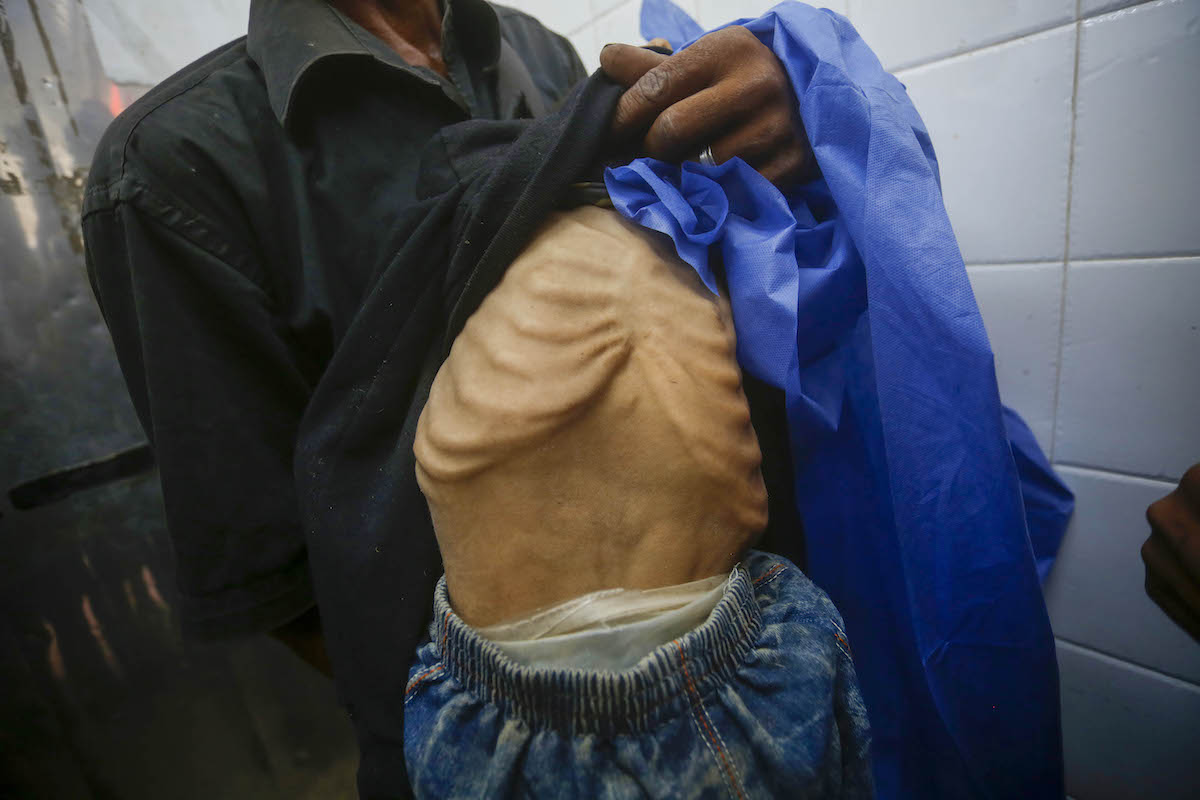 6 more Gazans, including 2 children, die from starvation amid Israeli siege