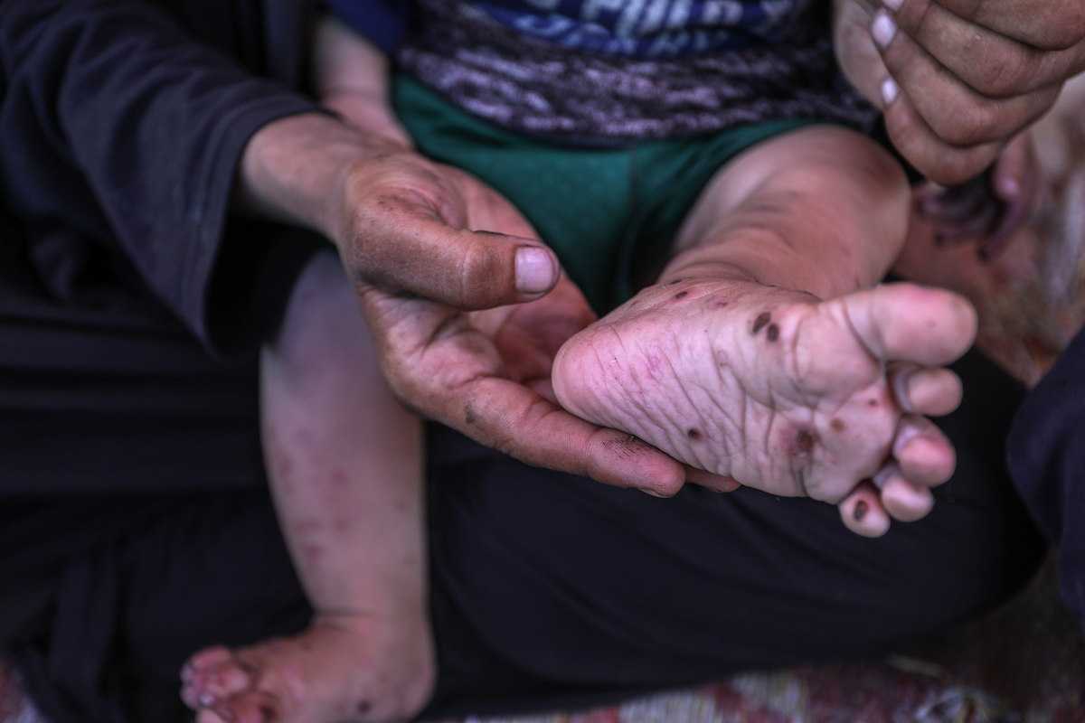 Gaza hospitals receiving large number of Palestinians with symptoms of unidentified illness: Health Ministry