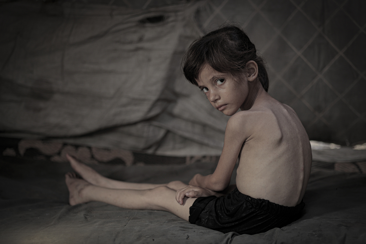 Five-year-old Lana Salih Juha, who fled with her family from Gaza’s Shuja'iyya neighborhood to the city center, suffers from severe malnutrition under Israel’s strict blockade and attacks, which affects infants and children the most, on July 28, 2025. [Mohammed Y. M. Al-yaqoubi - Anadolu Agency]