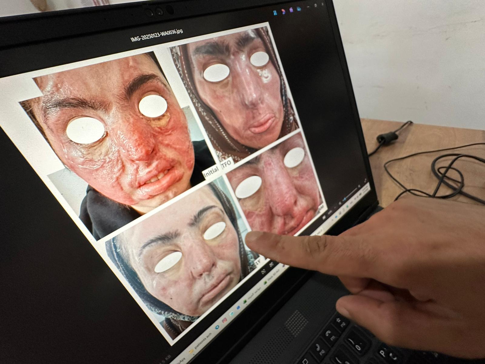 The technical team at Médecins Sans Frontières is developing transparent plastic masks to reduce the visible impact of war injuries on Palestinians in Gaza, on 25 May 2026 [Mohammed Asad/Middle East Monitor]